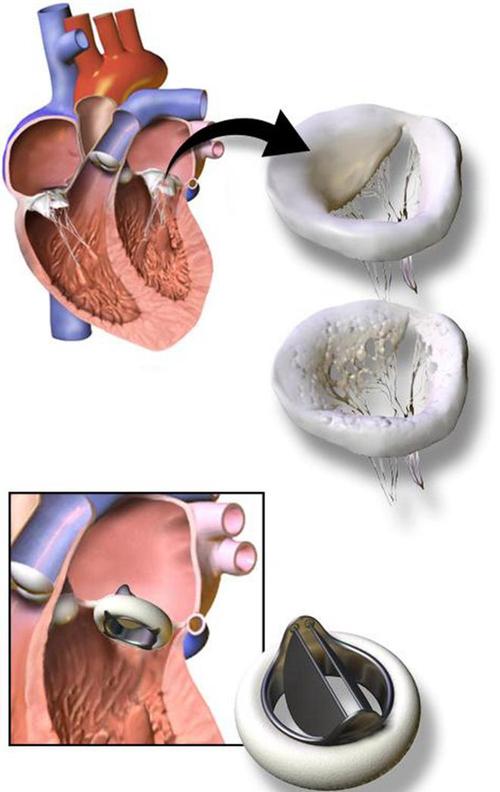 心脏瓣膜置换新技术，重塑生命之光
